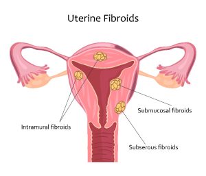 Phoenix fibroids treatment